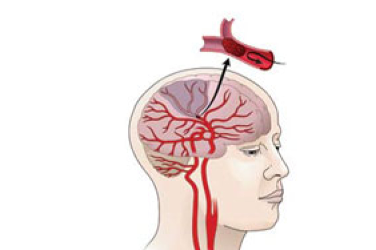 Új eljárást alkalmaztak akut stroke kezelésére a kaposvári kórházban